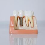 Dental Implantation: Fundamentals and Techniques